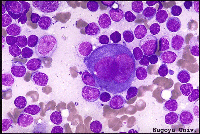 Reed Sternberg Cells