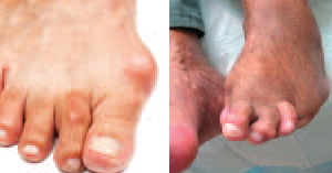 Foot Shapes with diabetic