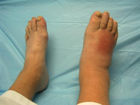 Swollen foot