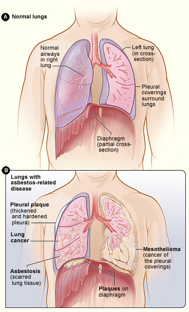 mesothelioma-Cancer