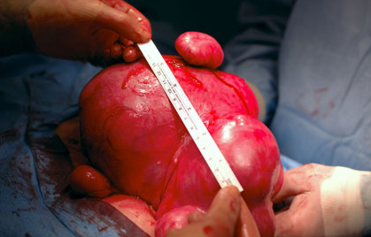 Uterine fibroids