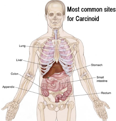 Common Sites of Carcinoid Cancer