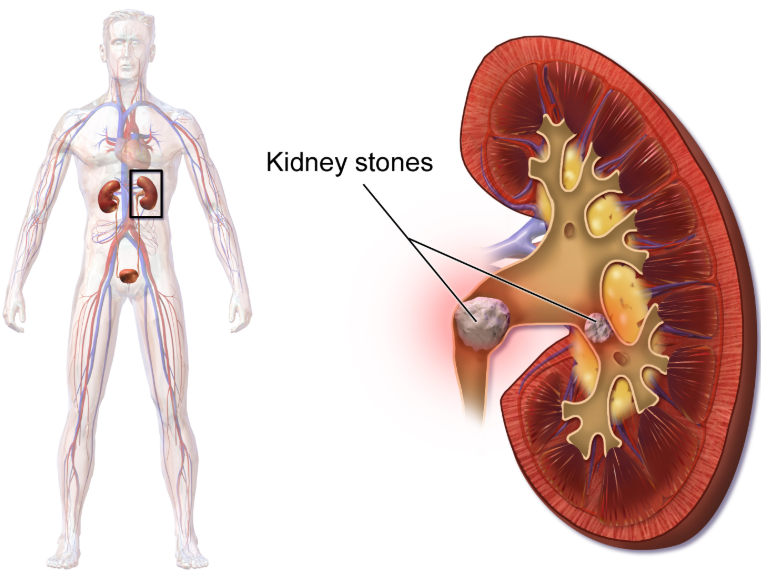 Kidney_stones_home_remedy