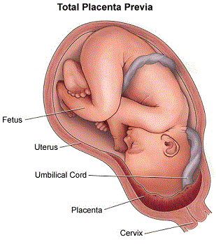 placenta previa in detail