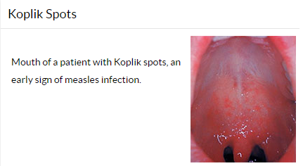 Measles koplik spots