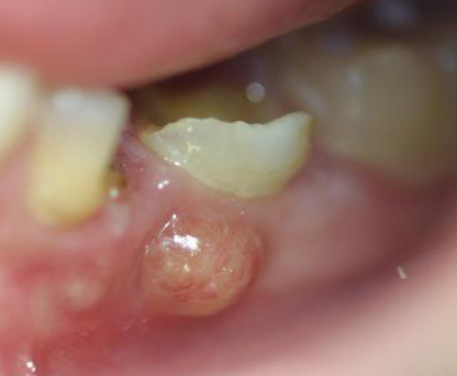 Is Over-The-Counter Mouth Abscess Treatment Effective?