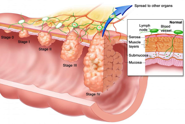 Risks Factors of Anal Cancer