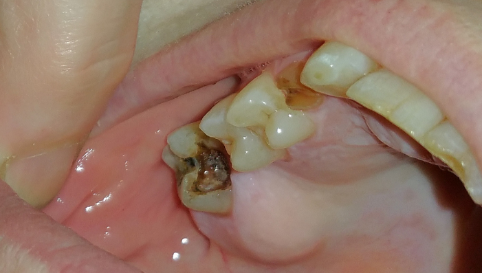 tooth abscesses