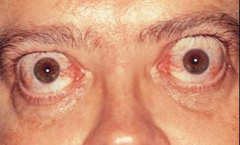 bulging-eyes-Graves-Disease