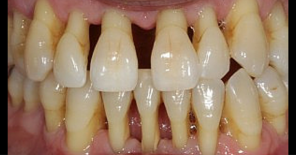 Sever receding gums